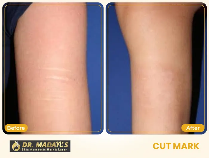 Cut mark before and after result 3 at Dr Madan Aesthetics